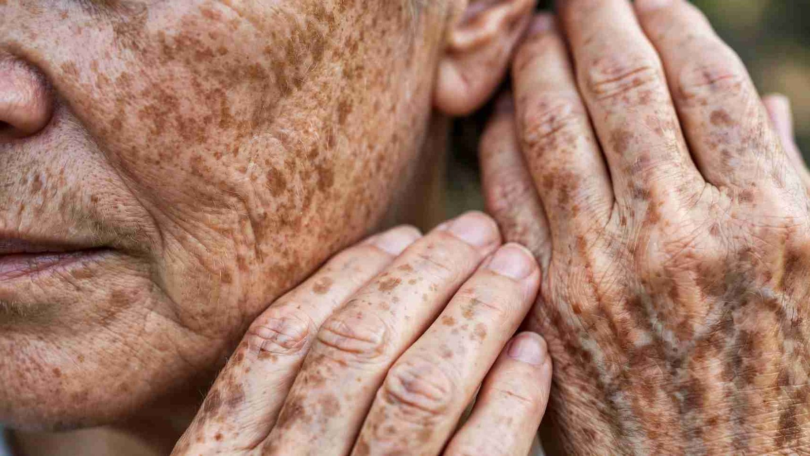 Premature Photoaging and Structural Collagen Breakdown